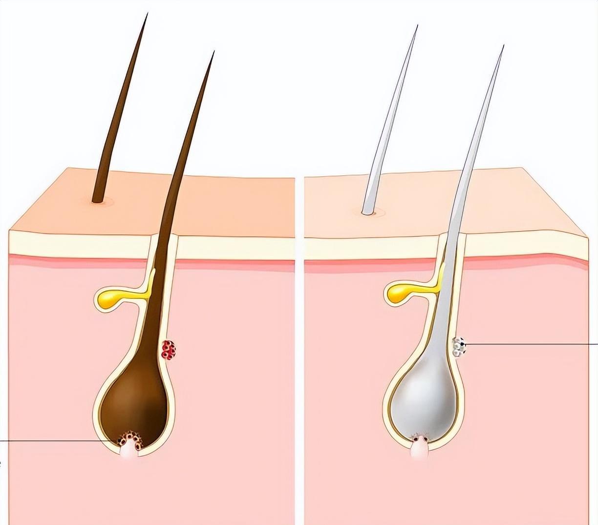 拔掉一根白發(fā)會(huì)長(zhǎng)十根白發(fā)嗎